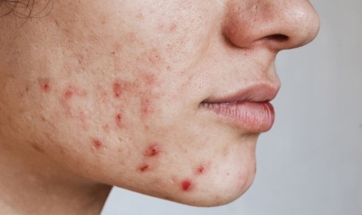 Germany&#039;s teenagers and young people have worst acne, with UK in the top 10, study finds